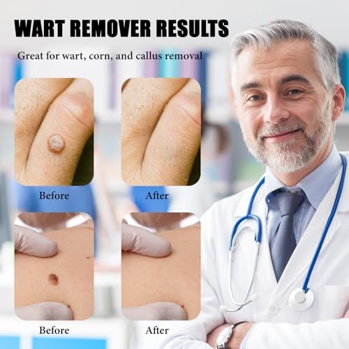 Yuejoikl skin tag removal kit with precise applicator and salicylic acid formula.