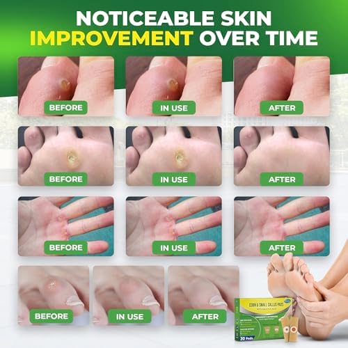 Athletes using Ulensy medicated bandages for callus prevention and relief.