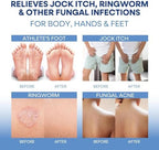 Hermon dual action system targeting ringworm jock itch and athlete's foot symptoms