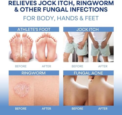 Hermon dual action system targeting ringworm jock itch and athlete's foot symptoms