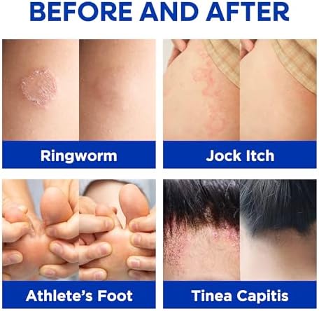 Hermon ringworm treatment cream container highlighting the tea tree oil and peppermint active ingredients