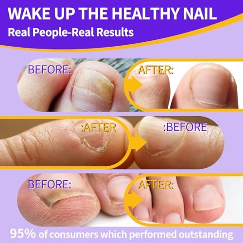Bee Venom anti-fungal soothing serum packaging for thick broken nails