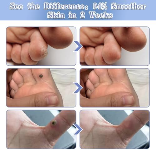 Lionax Aura skin tag removal solution being applied to a common hand wart.