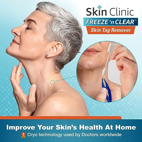 Cryogenic skin tag removal kit with precision tips and specialized tweezers for home use.