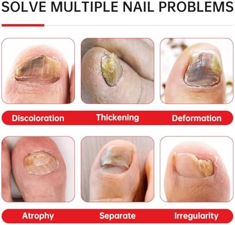 QQE antifungal liquid applicator being used on a thickened yellow toenail for repair.