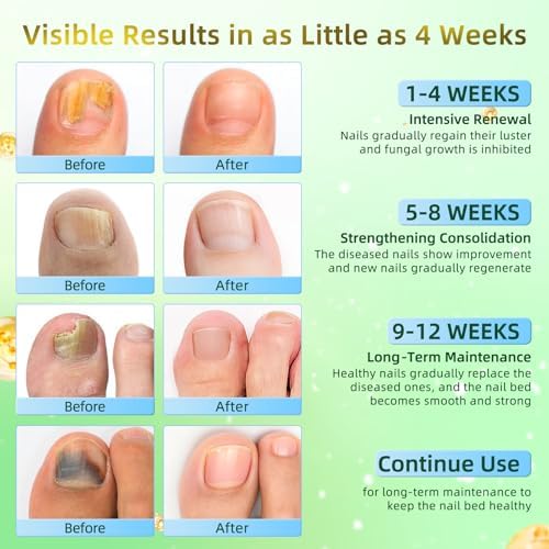 Precision antifungal pen for fingernail and toenail discoloration recovery.