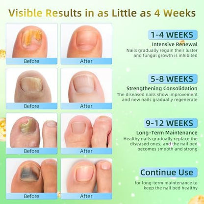 Precision antifungal pen for fingernail and toenail discoloration recovery.