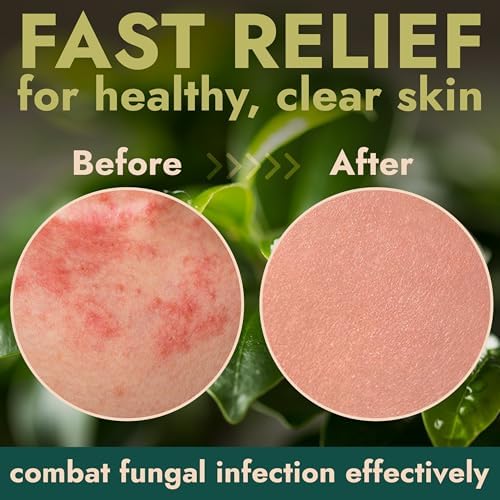 Terramed touch-free topical antifungal spray bottle for easy application on irritated skin