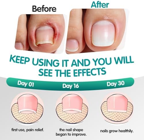 Before and after comparison using the painless at home pedicure tool for straightening curved nails.