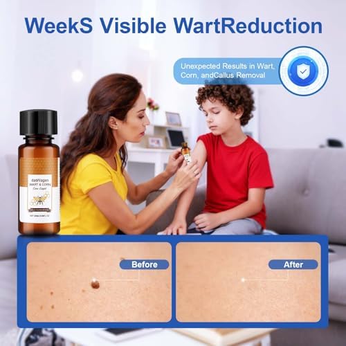 Before and after illustration of common wart removal using bee venom liquid.