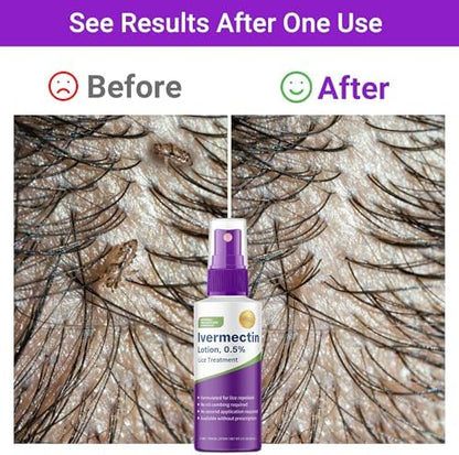 Side view of Shunniub Ivermectin topical lotion for head lice