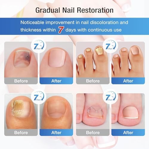 Application of Imperial Feet liquid to damaged toenail for fungus relief.