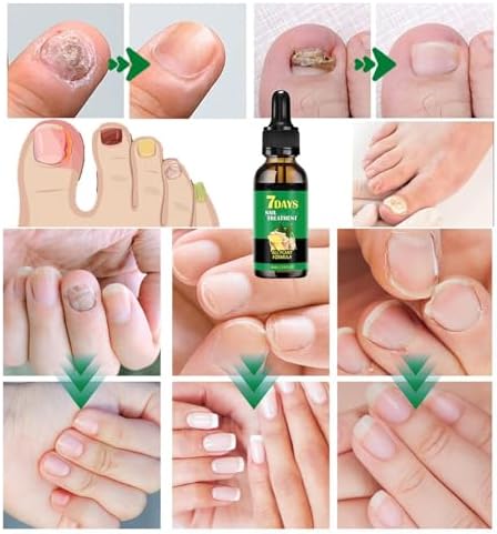 IMOLL nail treatment serum providing assistance with healthy nail growth and repair