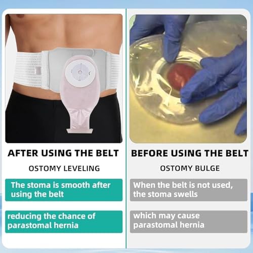 Side view of abdominal stoma support belt for ileostomy