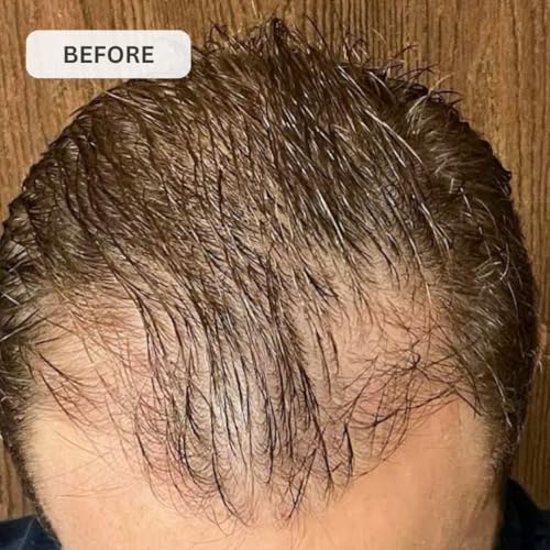 Kiierr low-level laser therapy device worn on head