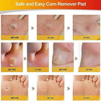 Application of a MYMULIKE corn remover pad on the side of a toe.