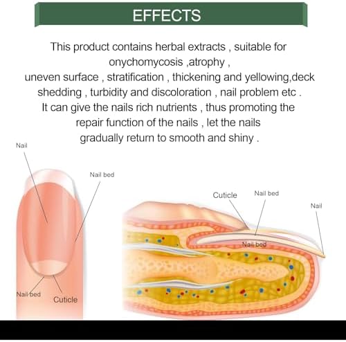 Applying nail fungus treatment to brittle toenail
