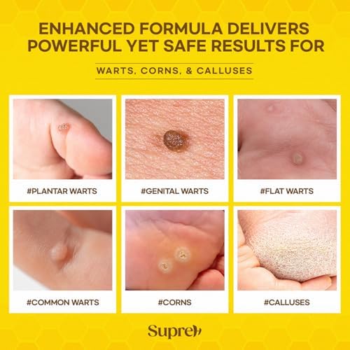 SupreH Salicylic Acid and Bee Venom liquid solution for plantar wart removal.