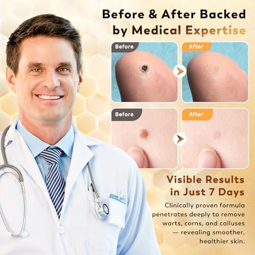 Before and after concept for Zozdal Bee Venom treatment on calluses and corns.