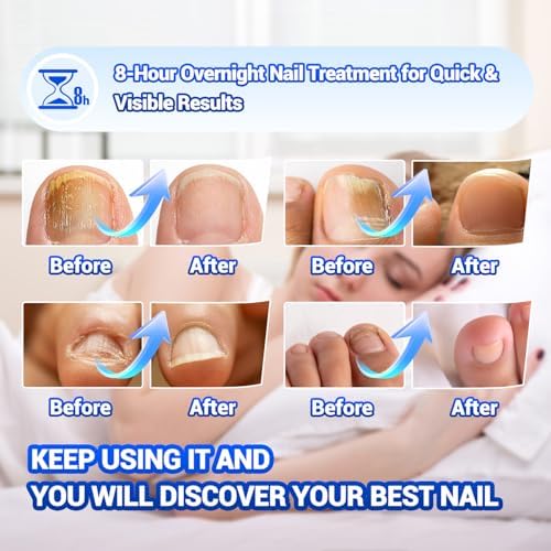OMO nail fungus treatment patches showing the breathable adhesive layer.