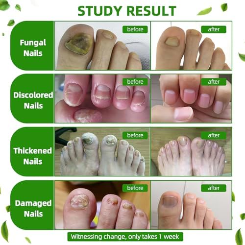 Natural plant extract formula for restoring damaged and broken nails.