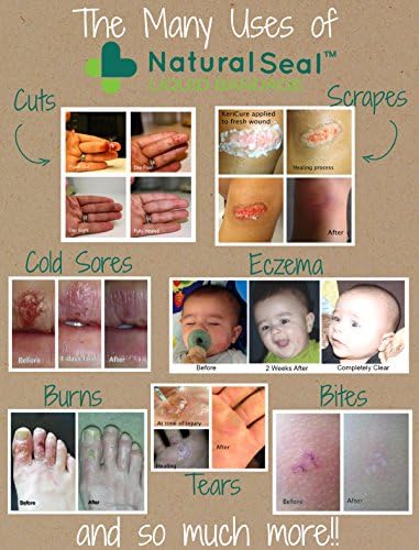 KeriCure itch relief spray for rashes and sensitive skin