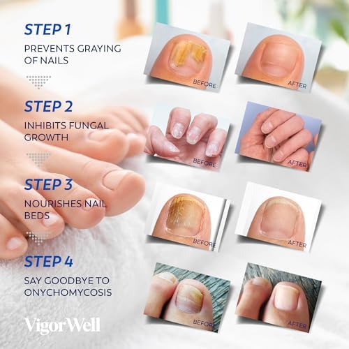 Skin toned antifungal patches for discreet overnight toenail repair therapy