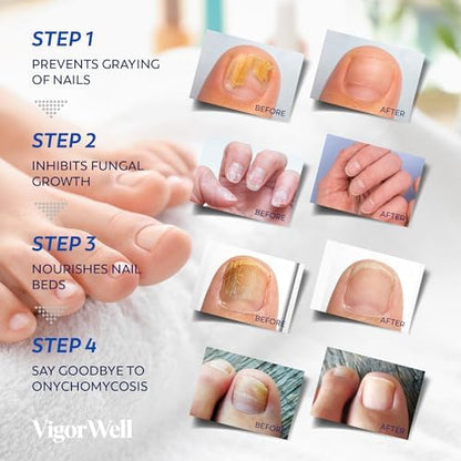 Skin toned antifungal patches for discreet overnight toenail repair therapy
