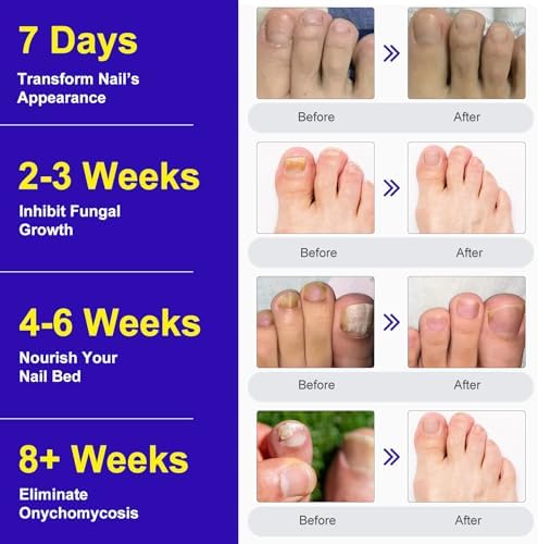 Authentic USA imported fungal nail treatment kit for home use