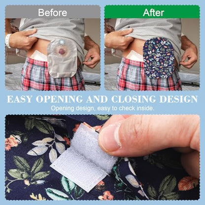 Odor reducing shower wrap cover for ileostomy pouch placement demonstration