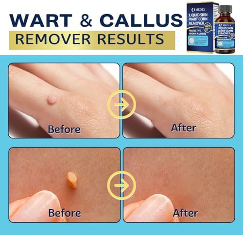 MEOLY 40 percent salicylic acid formula for fast-acting wart removal