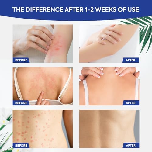 Charmpoo white cream texture for itchy skin relief in groin area