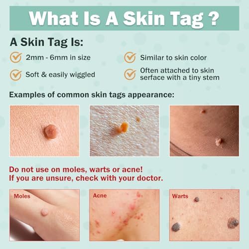 Dermatologist grade cryogenic freezing technology for skin tag removal