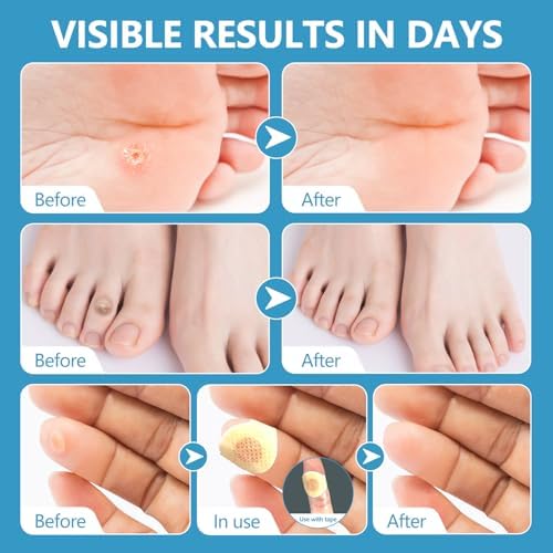 Step by step demonstration showing one step application of the targeted patch on a toe