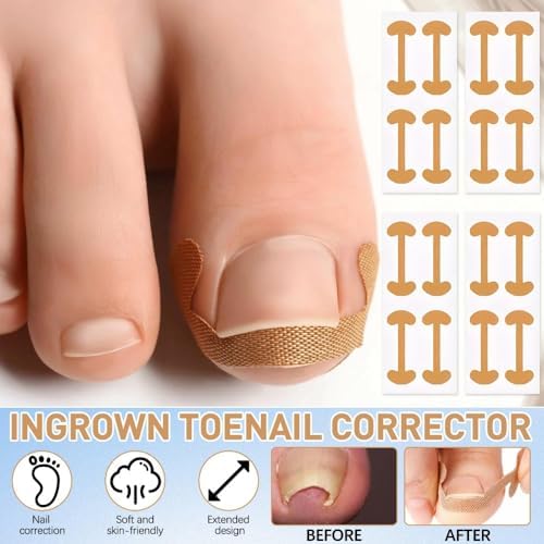 Step by step application of Ketsicart corrective stickers on a curved toenail for pain relief.