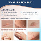 Close up of Claritag Squeeze and Freeze technology being applied to a skin tag.
