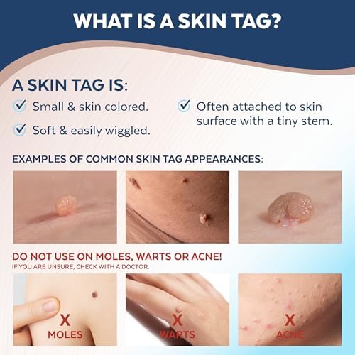Close up of Claritag Squeeze and Freeze technology being applied to a skin tag.