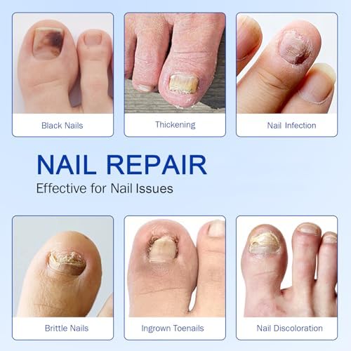 Before and after comparison using Fanshi herbal formula patches on brittle discolored toenails.