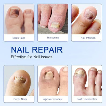 Before and after comparison using Fanshi herbal formula patches on brittle discolored toenails.