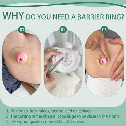Thirty pieces of medical grade ostomy cohesive seals individually packaged in hard plastic shells