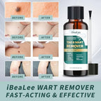 Close up of ELEFOCUS 12 percent salicylic acid liquid applicator for precise wart removal.
