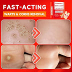 Plantar wart treatment patches showing the secure adhesive backing designed for daily walking.