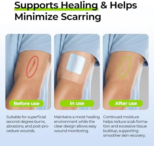 Sterile hypoallergenic burn pads for Indian home first aid kits.