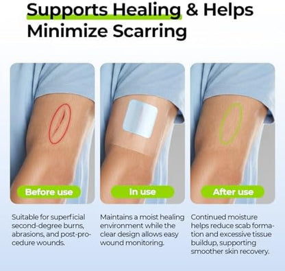 Sterile hypoallergenic burn pads for Indian home first aid kits.