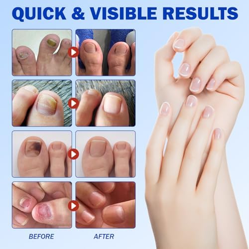 Hygienic 21 pieces sheet of Plethora antifungal hydrogel nail care patches.