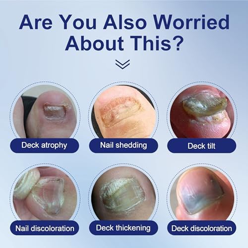 Topical liquid solution for thick broken and discolored fingernails and toenails.