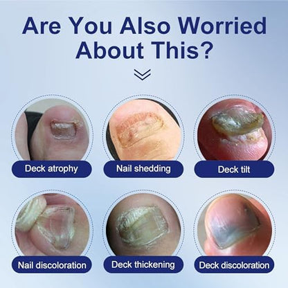 Topical liquid solution for thick broken and discolored fingernails and toenails.