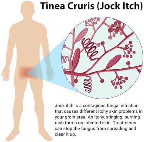 Full product line display of Ishancare Jock Itch Treatment for full body application.