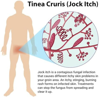 Full product line display of Ishancare Jock Itch Treatment for full body application.