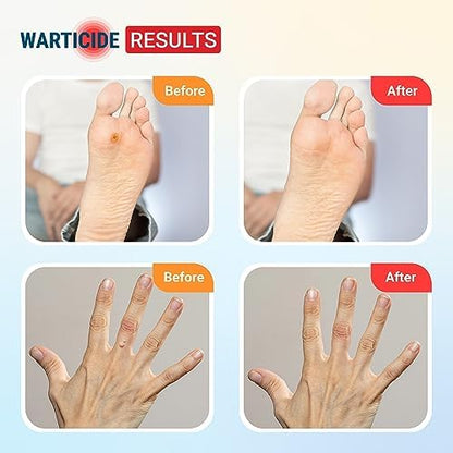 Max strength ten percent salicylic acid wart treatment for feet and hands.